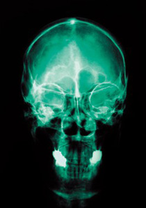 Philadelphia Brain Damage Lawyer - Radiogram of Cranium Image